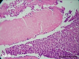 pilomatricoma-perforanting pilomatricoma