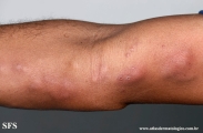 paracoccidioidomycosis-lymphatic_form
