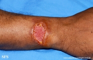 paracoccidioidomycosis-lymphatic_form