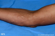 paracoccidioidomycosis-lymphatic_form