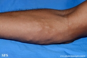 paracoccidioidomycosis-lymphatic_form
