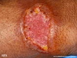 paracoccidioidomycosis-lymphatic_form