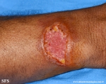 paracoccidioidomycosis-lymphatic_form