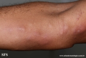 paracoccidioidomycosis-lymphatic_form