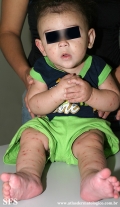 acrodermatitis infantile papular