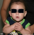 acrodermatitis infantile papular