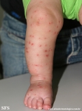 acrodermatitis infantile papular