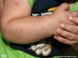 acrodermatitis infantile papular
