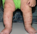 acrodermatitis infantile papular