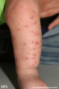 acrodermatitis infantile papular