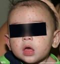acrodermatitis infantile papular
