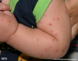 acrodermatitis infantile papular