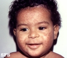 acrodermatitis infantile papular