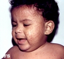 acrodermatitis infantile papular