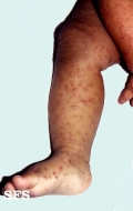 acrodermatitis infantile papular