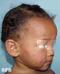 acrodermatitis infantile papular