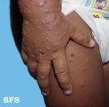 acrodermatitis infantile papular