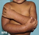 acrodermatitis infantile papular