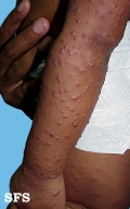 acrodermatitis infantile papular