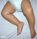 acrodermatitis infantile papular