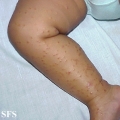 acrodermatitis infantile papular