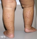 acrodermatitis infantile papular