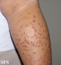 acrodermatitis infantile papular