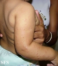 acrodermatitis infantile papular