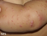 acrodermatitis infantile papular
