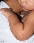 acrodermatitis infantile papular