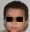 acrodermatitis infantile papular