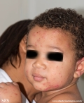 acrodermatitis infantile papular