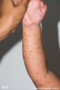 acrodermatitis infantile papular