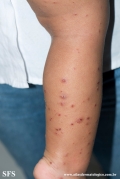 acrodermatitis infantile papular