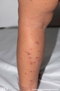 acrodermatitis infantile papular