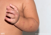 acrodermatitis infantile papular
