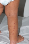 acrodermatitis infantile papular