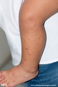 acrodermatitis infantile papular