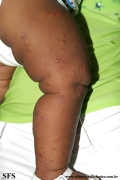 acrodermatitis infantile papular