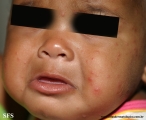 acrodermatitis infantile papular