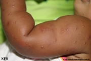 acrodermatitis infantile papular
