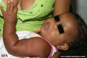 acrodermatitis infantile papular