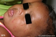 acrodermatitis infantile papular