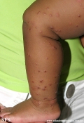 acrodermatitis infantile papular