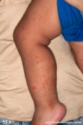 acrodermatitis infantile papular