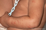 acrodermatitis infantile papular