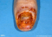 onychopapilloma