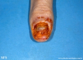 onychopapilloma