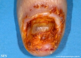 onychopapilloma