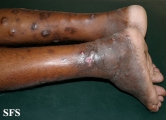 leprosy lepromatous